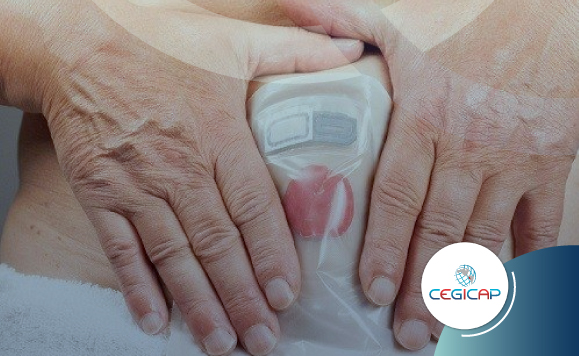 CURACIÓN DE HERIDAS Y OSTOMÍAS